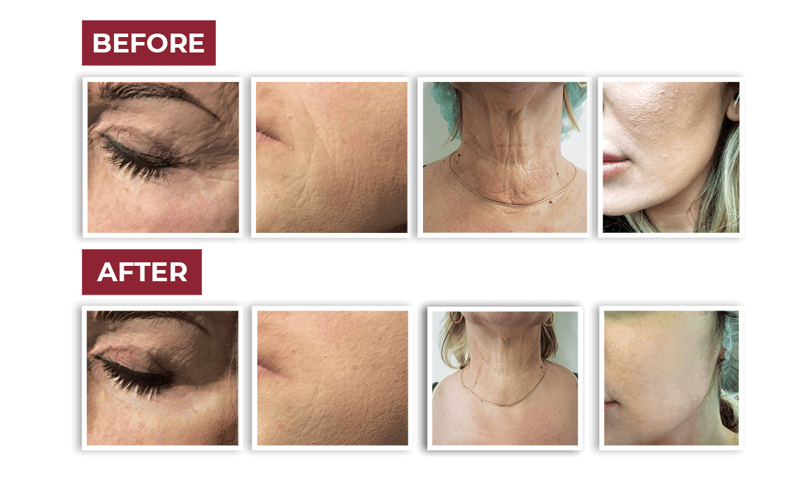 Skin Comparison Plinest Skin Comparison Plinest